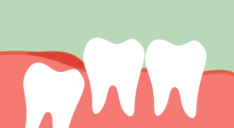 Tekst o problemach zatok wywołanych chorobami zębów. Na zdjęciu: Zbliżenie zębów - HelloZdrowie