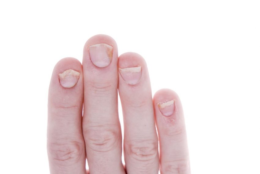 Palce z łuszczycą paznokci