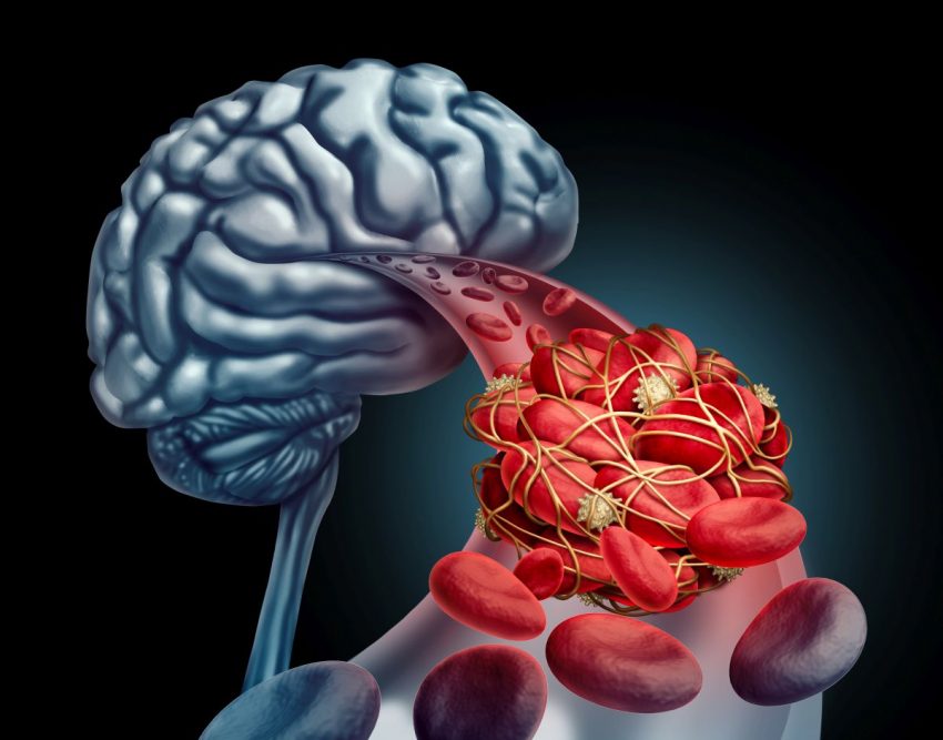 Graficzne przedstawienie miażdżycy mózgu