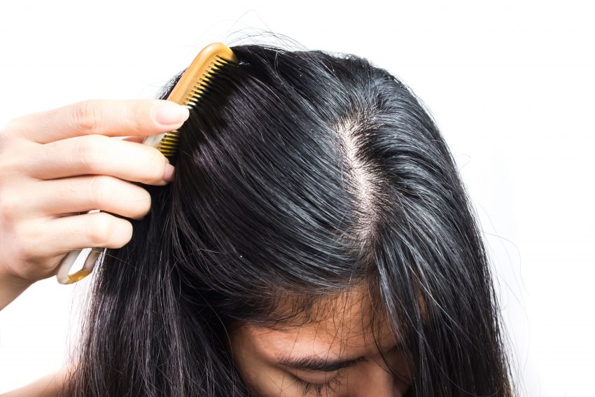 włosy - łojotokowe zapalenie skóry głowy