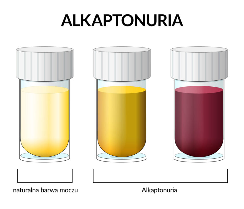 Alkaptonuria to choroba, która objawia się zmianą koloru moczu