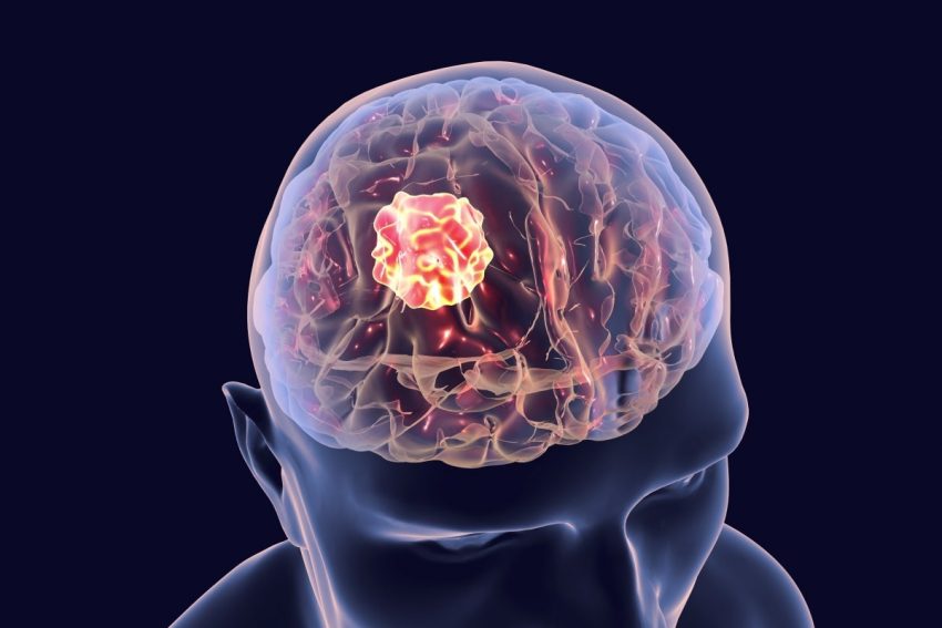 ilustracja 3D raka mózgu