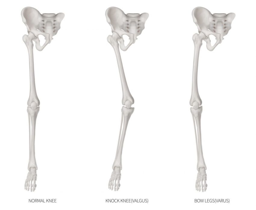 szkielet ukazujący kości nogi zdrowej oraz z krzywicą