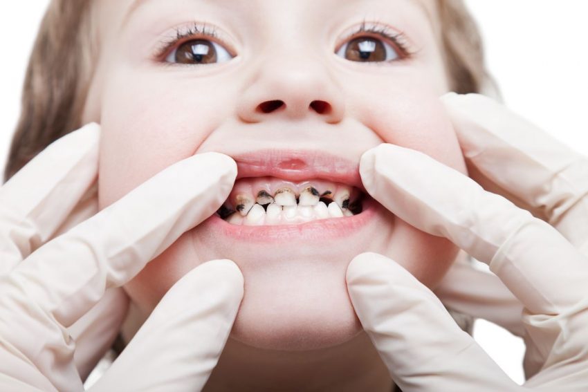 Stomatolog ogląda zęby dziewczynki, która cierpi na próchnice. Jej zęby są całe czarne.