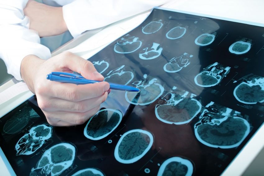 lekarz oglądający zdjęcia rtg mózgu - apraksja