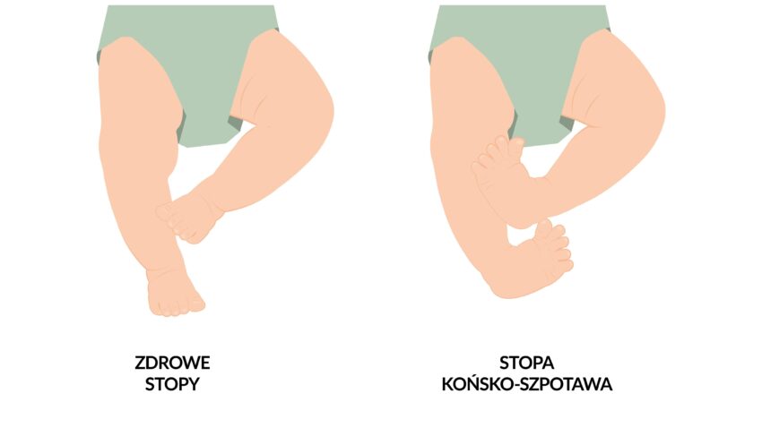 Na zdjęciu: Grafika pokazuje, w jaki sposób układają się nogi zdrowego dziecka i niemowlaka chorującego na atrogrypozę (tzw. stopa końsko-szpotawa).