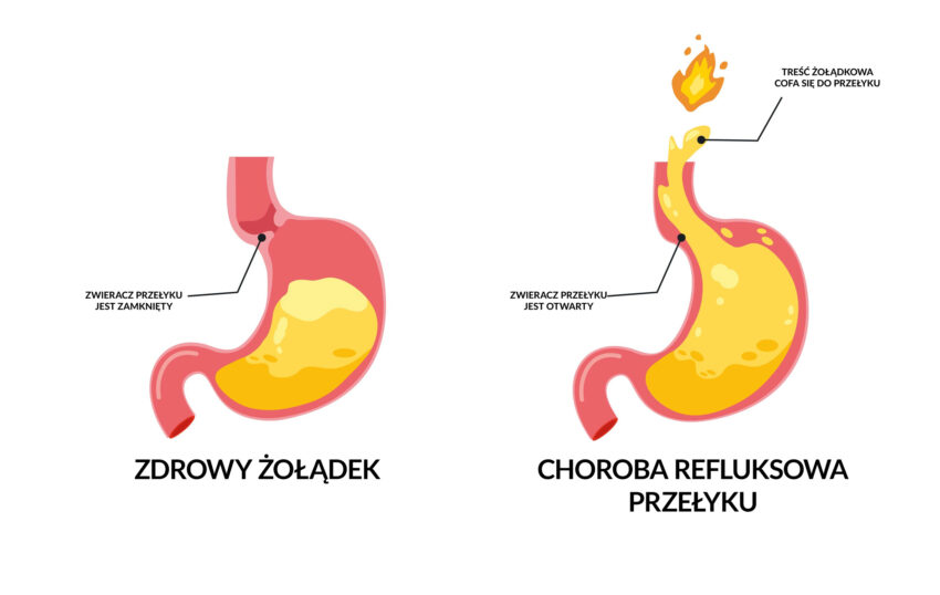 Na schemacie przedstawiono wizualizację tego, jak wygląda zdrowy żołądek, a co się dzieje w organie dotkniętym refluksem.