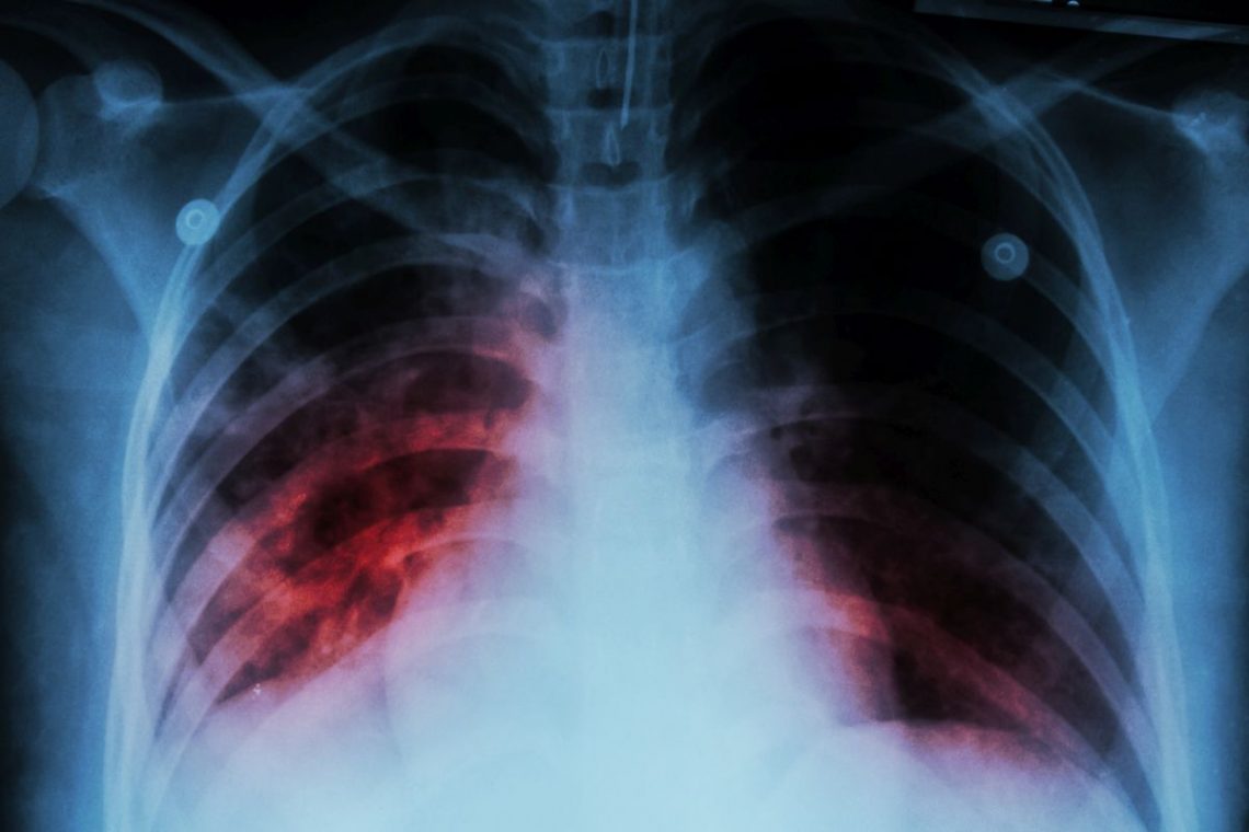 Zdjęcie rentgenowskie przedstawiające chorobę