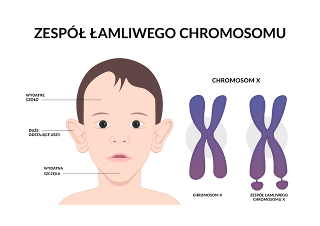 Schemat przedstawia charakretyczne objawy zespołu łamliwego chromosomu x.