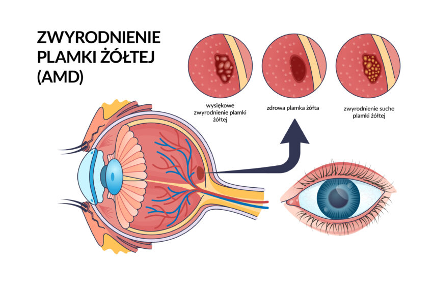 Na zdjęciu schemat przedstawiający zwyrodnienie plamki żółtej.