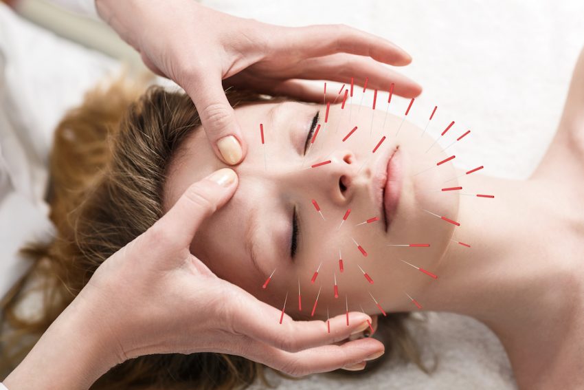 Kobieta podczas zabiegu akupunktury.