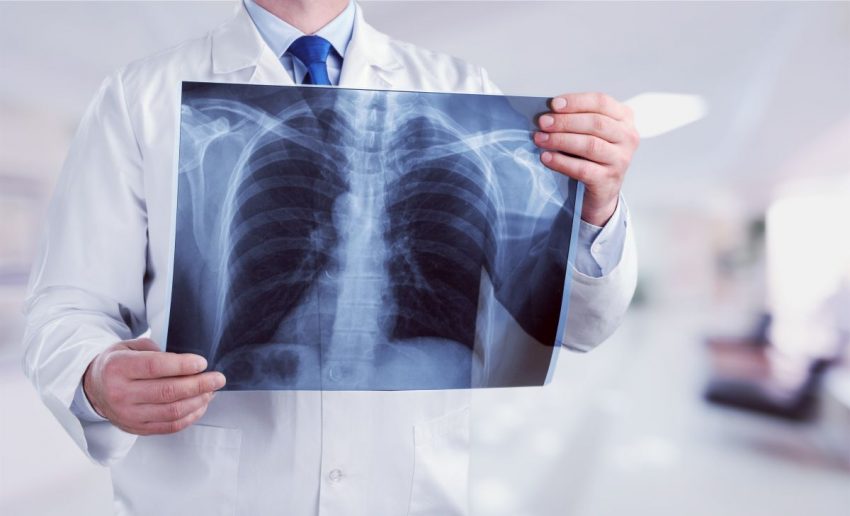 Lekarz trzyma w ręku rentgen płuc