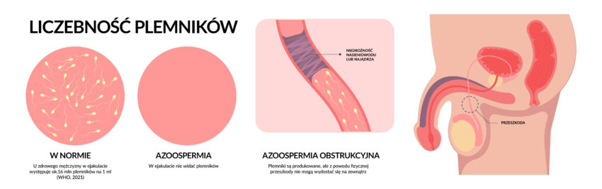 Schemat opisujący, czym jest azoospermia i jej porównanie do zdrowego nasienia.