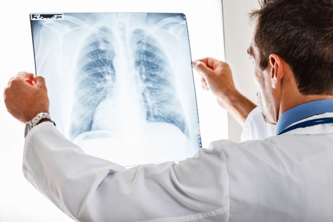 Lekarz ogląda pod światło zdjęcie rentgenowskie płuc