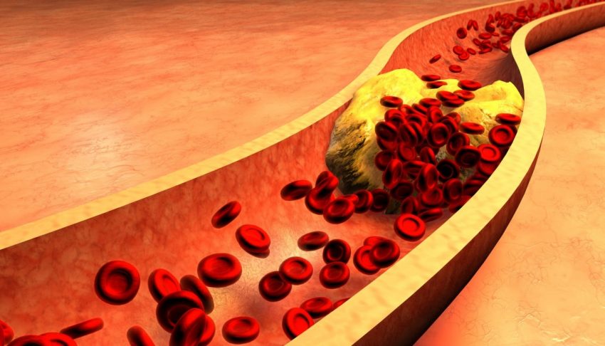 cholesterol blokujący tętnicę w 3D