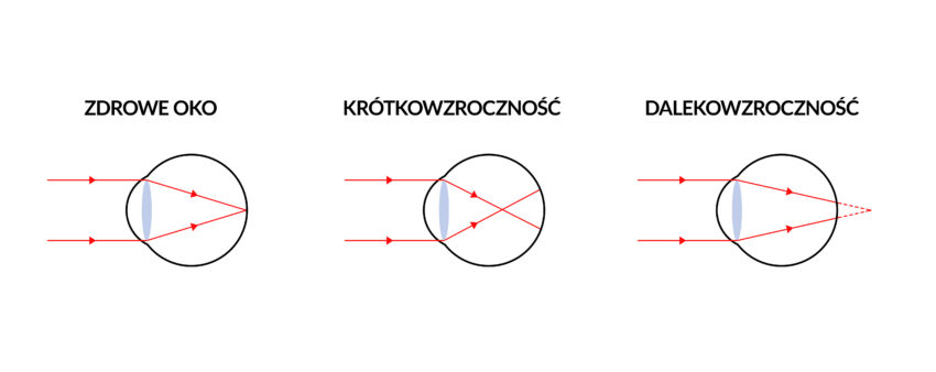 Na uproszczonym schemacie widać, w jaki sposób odbierane jest światło przez osoby zdrowe, z krótkowzrocznością i dalekowzrocznością.