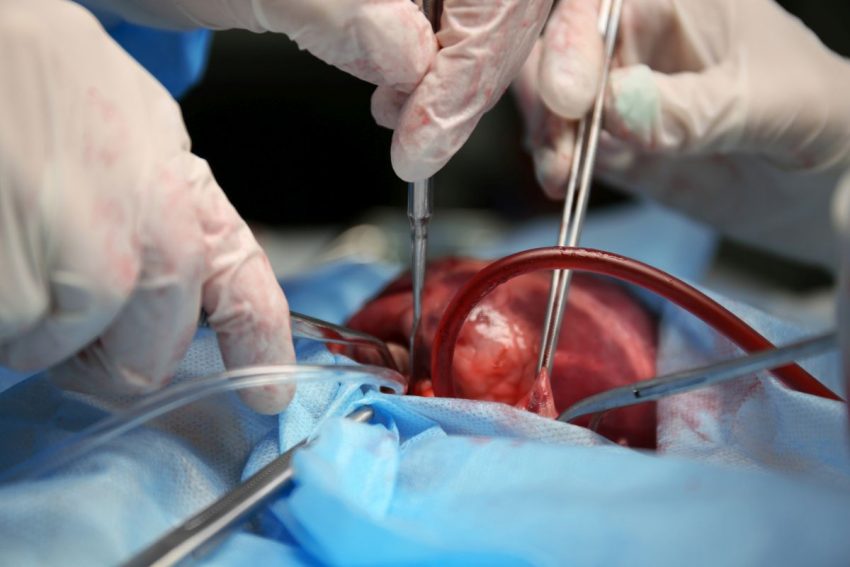 Lekarze chirurdzy podczas wykonywania przeszczepu serca