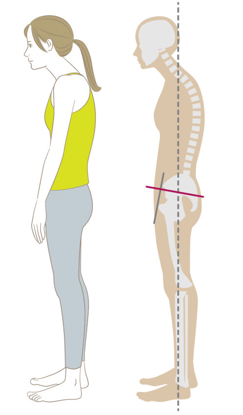 Na rysunku zgarbiona kobieta i wygląd jej kręgosłupa