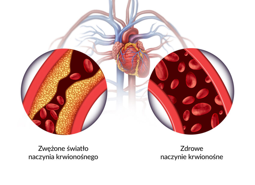 Na schemacie widać zwężone światło naczyń krwionośnych spowodowane wysokim poziomem cholesterolu oraz zdrowe naczynie.