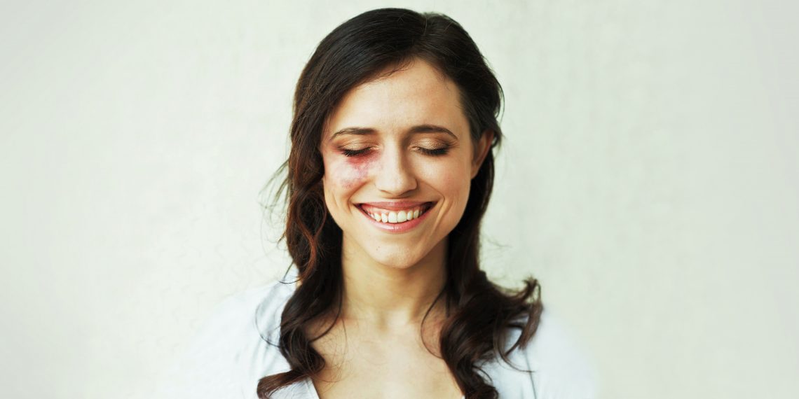 Tekst o akceptacji znamion naczyniowych i profil NaTwarzyPL. Na zdjęciu: Kobieta z ciemnymi włosami uśmiechająca się - HelloZdrowie