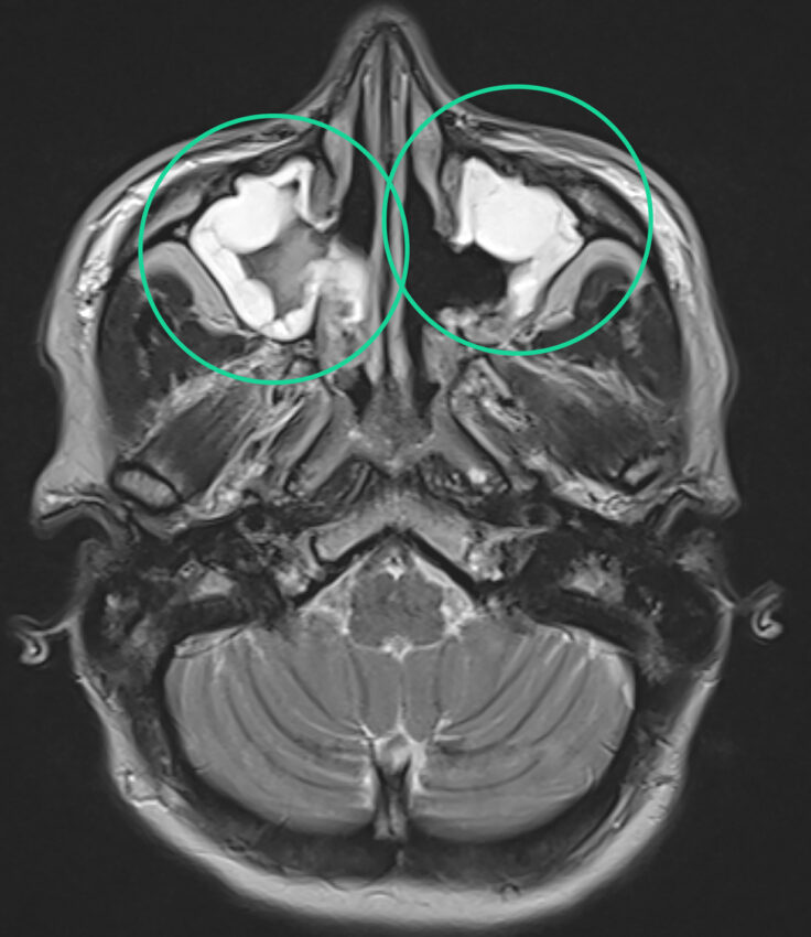 Na zdjęciu MRI widać przewlekłe zapalenie zatok (sinusitis) przynosowych. 