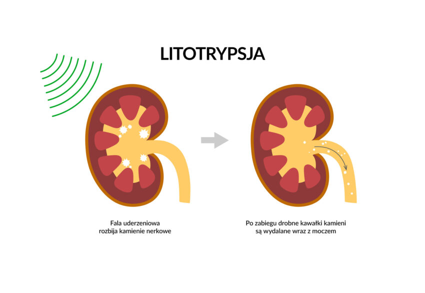Schemat przedstawiający koncepcję zabiegu litotrypsji. Widać na nim, jak fala uderzeniowa oczyszcza nerkę z kamieni.