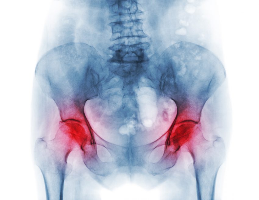 Osteopenia - jakie daje objawy i jak się ją leczy?