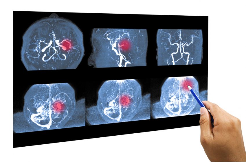 Badanie angio-tk - na czym polega tomografia naczyń krwionośnych?