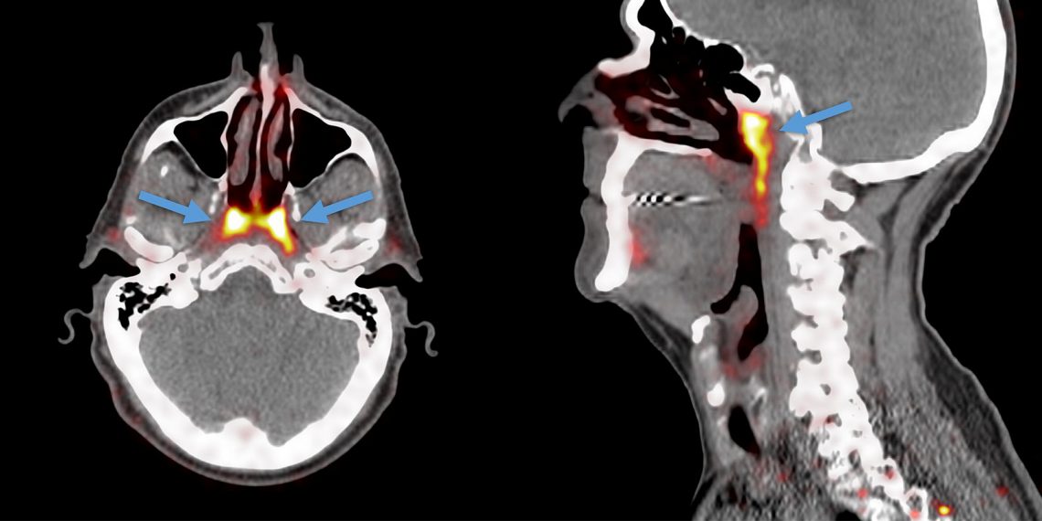 Tekst o odkryciu nowych gruczołów w głowie człowieka. Na zdjęciu: Zbliżenie tomografii komputerowej - HelloZdrowie