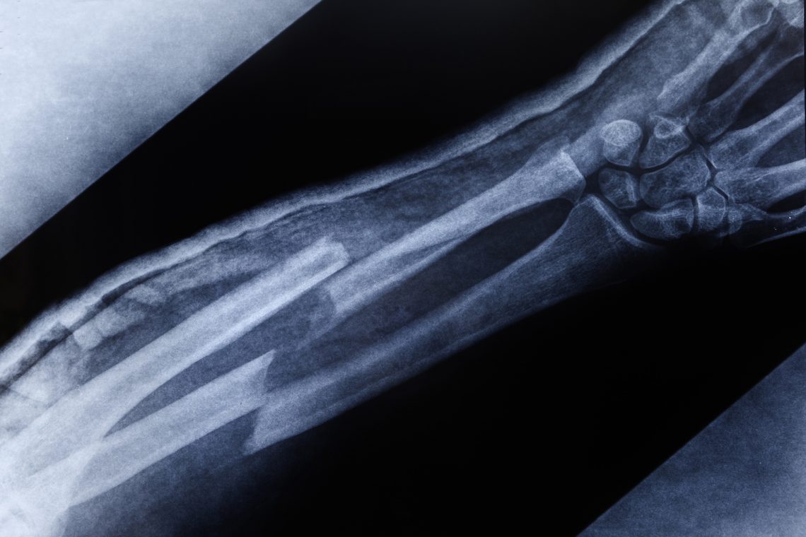 Tekst o: objawach, typach i leczeniu wrodzonej łamliwości kości. Na zdjęciu: Rentgen dłoni - HelloZdrowie