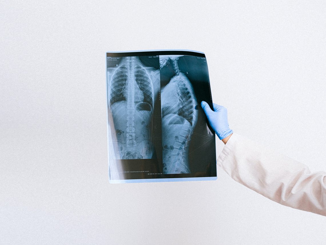 Tekst o przyczynach i leczeniu zarostowego zapalenia oskrzelików. Na zdjęciu: Ręka trzymająca rentgen - HelloZdrowie