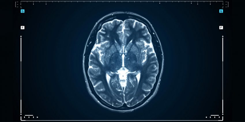 Skan mózgu pozwoli na wykrycie alzheimera / istock