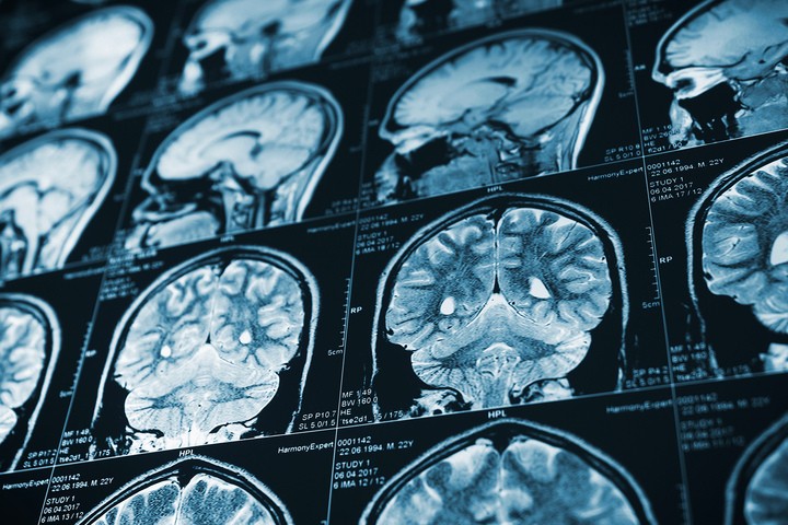 Rezonans magnetyczny - obraz udaru mózgu mózgu
