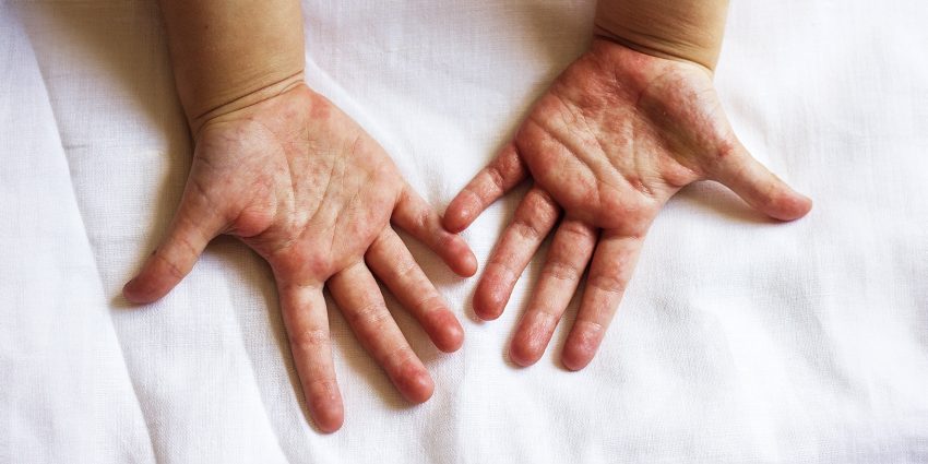 Szkarlatyna (płonica) to bakteryjna choroba zakaźna wieku dziecięcego wywoływana przez paciorkowca typu A - na zdjęciu dłonie dziecka chorego na szkarlatynę z charakterystyczną drobną wysypką