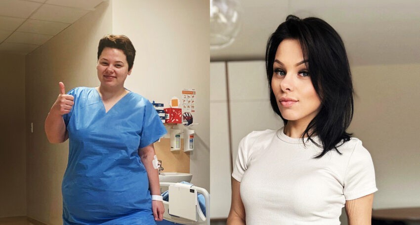 Anna Niedużak przed i po operacji