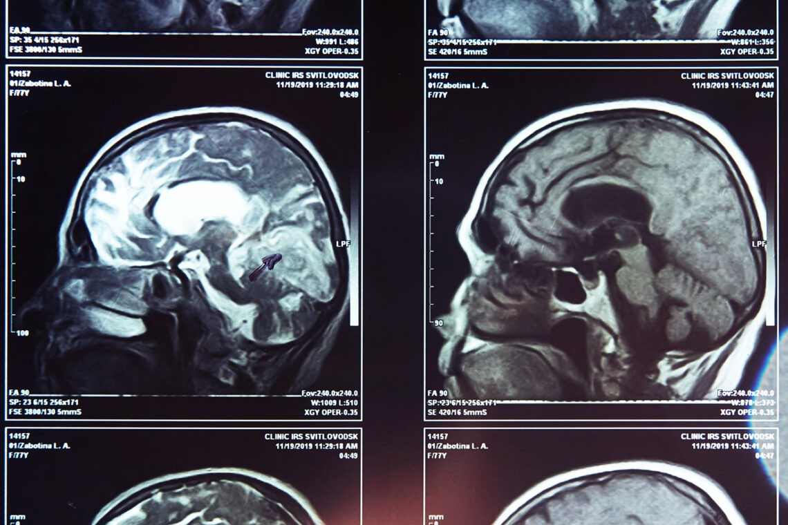 Zdjęcia rentgenowskie mózgu- Hello Zdrowie