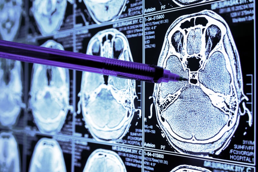 Skany mózgu z badań MRI- Hello Zdrowie