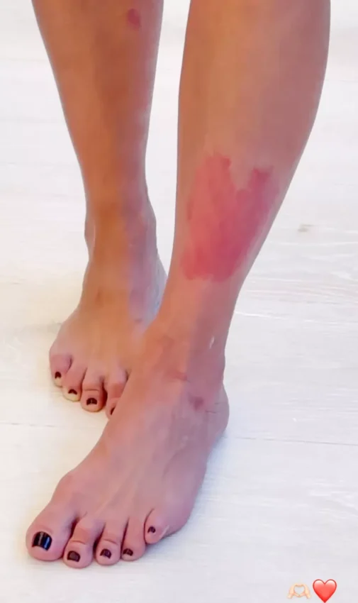 Nogi Kim Kardashian z czerwonymi plamami, które są zmianami łuszczycowymi