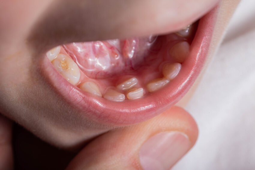 Na zdjęciu: wnętrze jamy ustnej dziecka z dodatkowymi zębami, tekst o hieprdoncji /fot. Adobe Stock