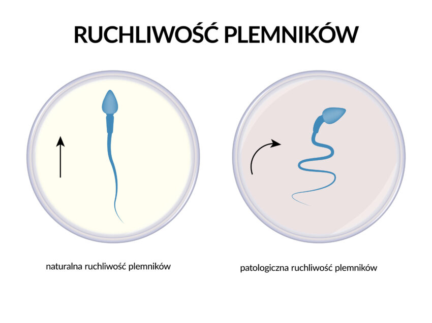 Schemat przedstawia ruchliwość plemników w athenozoospermii