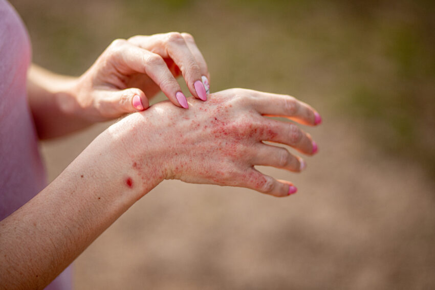 na zdjęciu: kobiece dłonie z atopowym zapaleniem skóry, tekst o atopowym zapaleniu skóry i możliwościach jego leczenia /fot. Adobe Stock