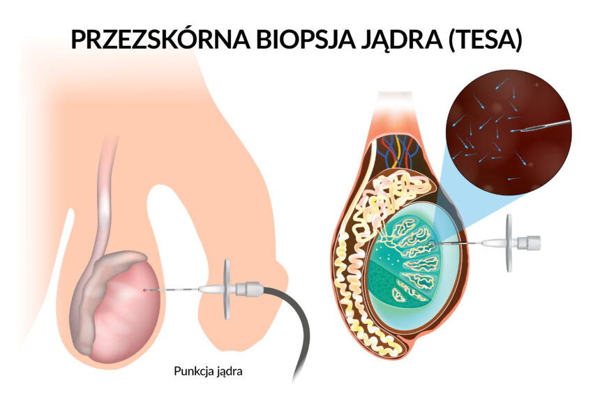 Schemat wykonania biopsji jądra w przedstawieniu graficznym 