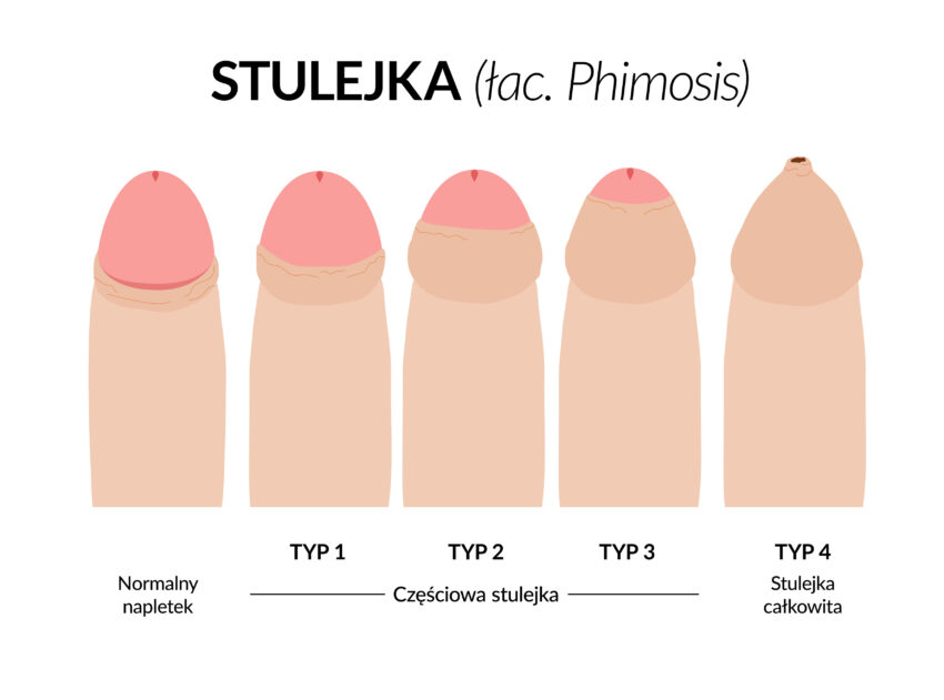 Schemat przedstawia różne typy stulejki.