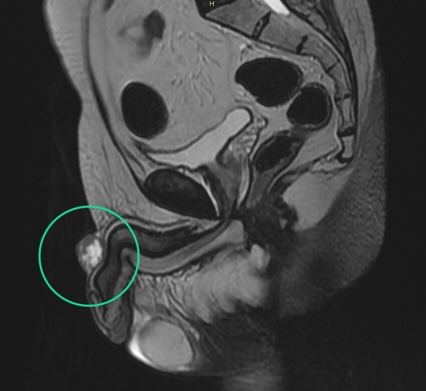 Na zdjęciu MRI (rezonans magnetyczny) przedstawiony jest w zielonym kółku rak prącia. 