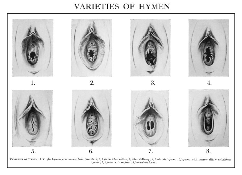 Na zdjęciu: Rysunki różnych kształtów błon dziewiczych (hymen)