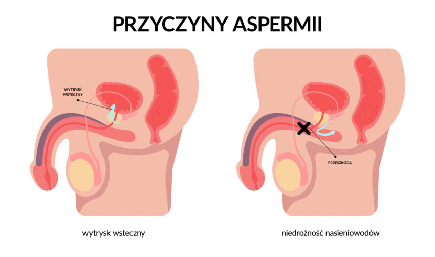 Schemat przedstawia możliwe przyczyny aspermii 