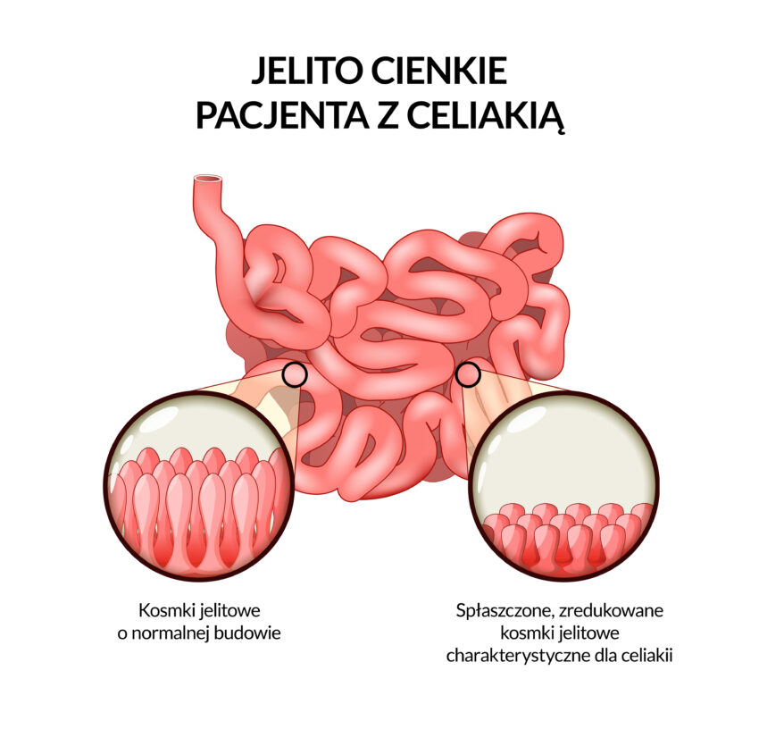 Na zdjęciu: Kosmki jelitowe u osoby zdrowej i chorej na celiakię.