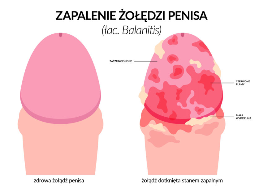 na zdjęciu schemat przedstawiający czerwone plamy na żołędzi, które mogą być objawem grzybicy penisa; mają wtedy postać wysypki.