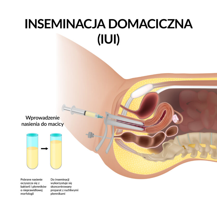 Na zdjęciu schemat wykonania inseminacji domacicznej.