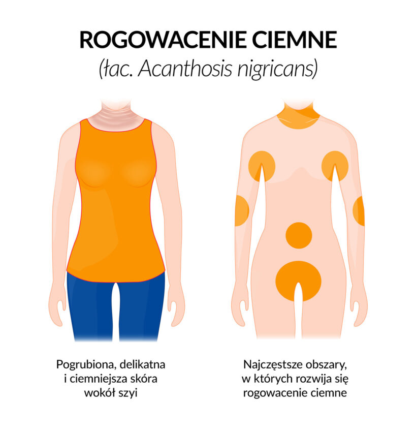 Schemat pokazuje na sylwetce kobiety, gdzie najczęściej pojawiają się objawy insulinoopornośći - rogowacenia ciemnego.